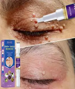 피부 제거액 얼굴 스킨 케어 제거 바디태그, 3ml, 1개